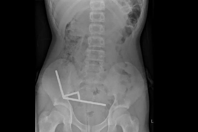 新西兰男童吞百片网购磁铁 肠道部分组织坏死新西兰一名13岁男童吞下多达100片在Temu购买的高功率钕铁硼磁铁，必须动手术取出磁铁，部分坏死组织也被切除
