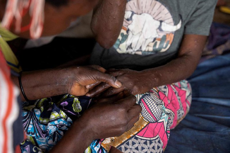 去年初以来猴痘疫情已致非洲1800余人死亡自去年初以来，非洲已报告4万多起猴痘确诊病例，超过1800人死亡